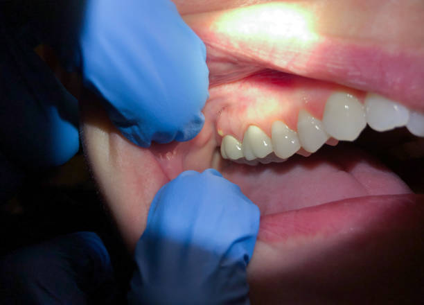 Best Emergency Broken Tooth Repair in Pasatiempo, CA